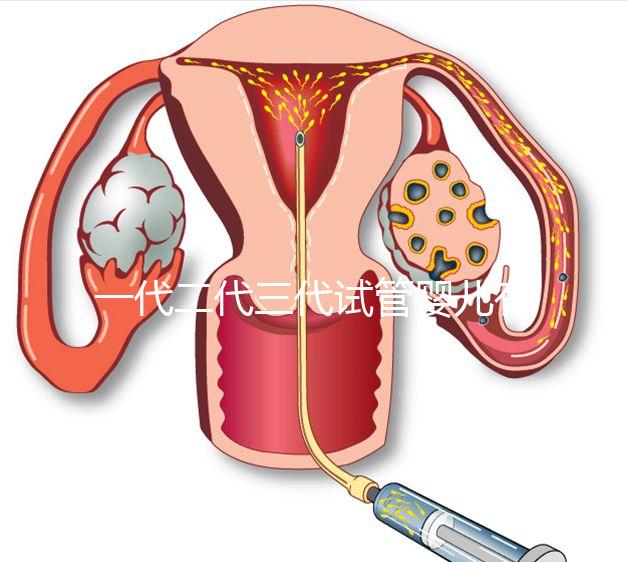 一代二代三代試管嬰兒有什么區別?