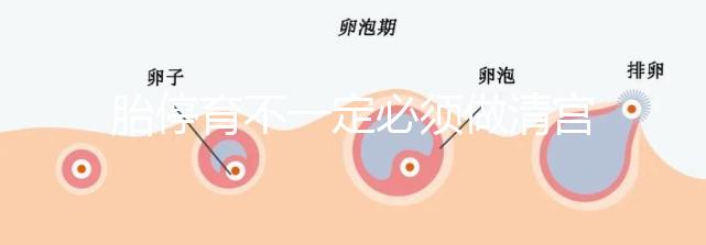 胎停育不一定必須做清宮！不滿足這3種情況,無需要刮宮